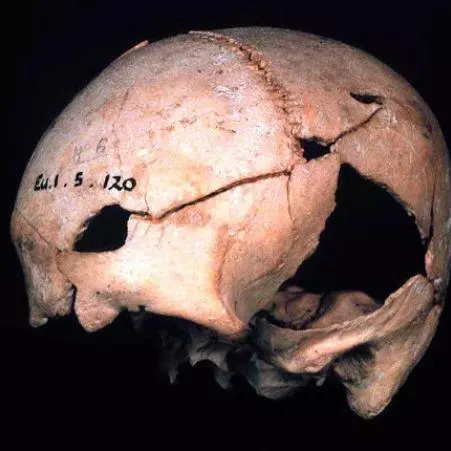 Coldrum, unhealed cranial trauma (Duckworth Laboratory, Cambridge, Eu.1.5.120)